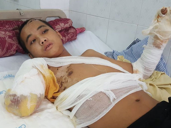 Bố chết mẹ bỏ đi biền biệt, chàng trai đang một mình nuôi 5 em nhỏ bỗng bị điện giật cụt tay, sống lay lắt