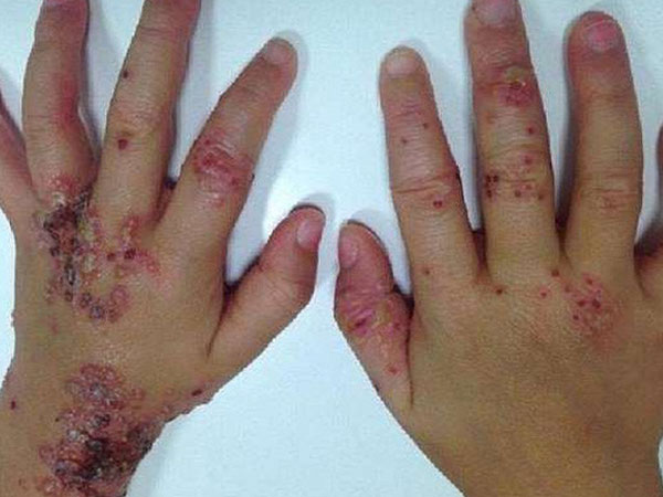 Bé gái 3 tuổi bị mụn rộp, lở loét đến phát sợ - thêm một nạn nhân của 'nụ hôn thần chết'