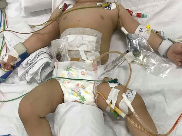 Bé trai 11 tháng tuổi bị mẹ ruột dùng dao đâm nhiều nhát vào bụng nguy kịch