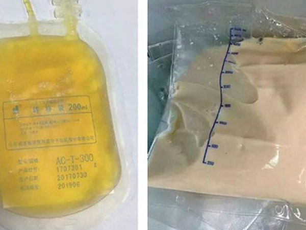 Bác sĩ giật mình khi máu bệnh nhân có lớp váng như mỡ, do ăn những món ai cũng thích