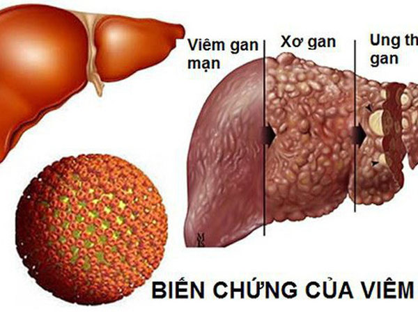 Căn bệnh nguy hiểm có thể dẫn đến ung thư gan: Tốn 400 triệu vẫn không chữa được