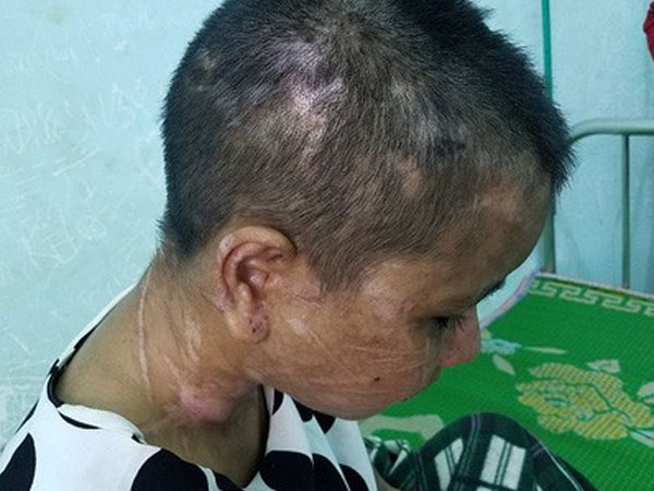 Lời kể rùng rợn của cô gái nghi bị chủ tra tấn dã man