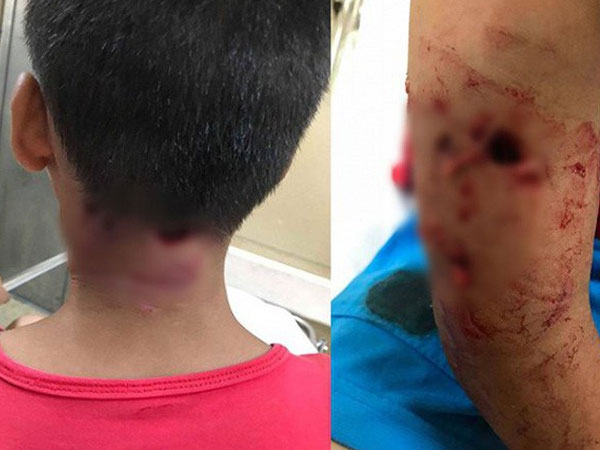Thêm một bé trai bị chó cắn thủng tay và gáy khi cho chó ăn