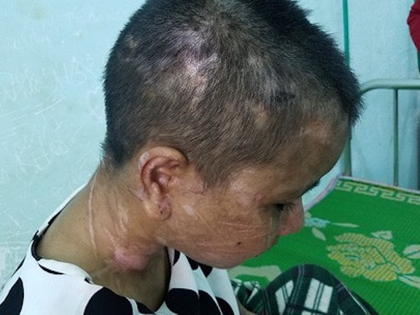Vụ tra tấn dã man người làm: Chị Y Nhiêu được tài trợ thẩm mỹ miễn phí