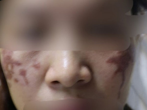 Mặt loang lổ sạm đen vì chấm axit chữa nám da