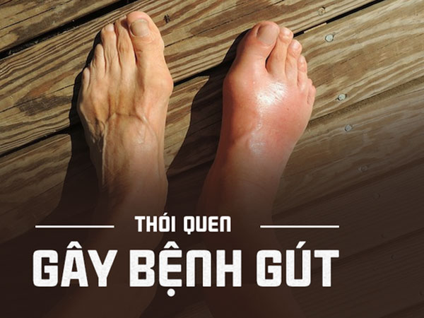 Nhiều người vô tình làm những việc này, đến khi đau không đi nổi mới biết bị mắc bệnh gút