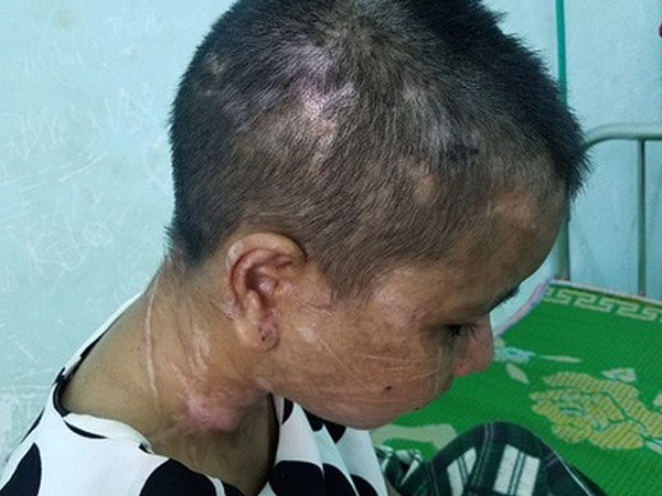 Vụ cô gái bị tra tấn dã man như thời trung cổ: Y Nhiêu được bác sĩ Chiêm Quốc Thái tài trợ phẫu thuật miễn phí
