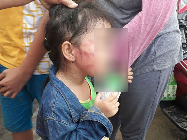 TP.HCM: Bé gái 5 tuổi nghi bị bảo mẫu tát liên tục đến sưng mặt, dọa lấy kéo cắt lưỡi nếu nói cho gia đình biết