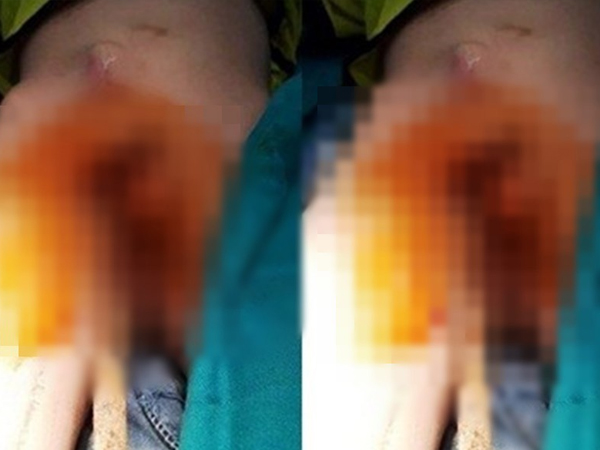 Nhảy từ trên tường xuống dưới, bé trai 6 tuổi bị thanh sắt đâm xuyên qua người