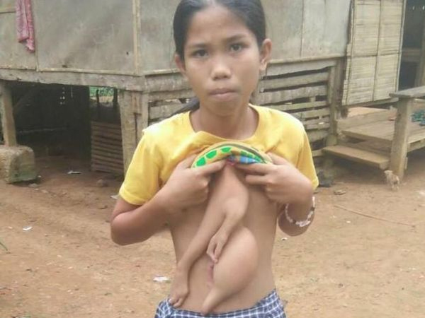 Bé gái 14 năm sống chung với 2 cánh tay thừa lủng lẳng trên ngực và bụng