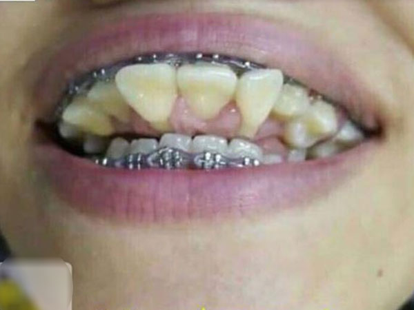 Xôn xao hàm răng chổng ngược khiến ai cũng hoảng hốt, biết lý do lại càng đau lòng