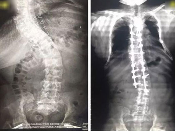 Sáng dậy cô gái 17 tuổi bỗng thấy lùn đi 5cm, nhìn phim chụp liền hiểu lý do
