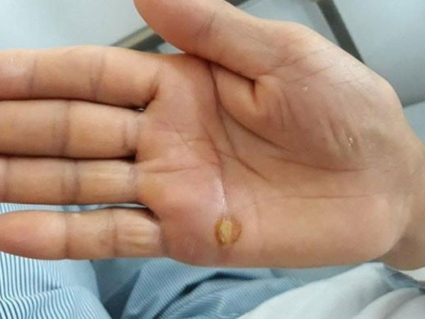 Cứng hàm, mất cảm giác vì vết thương nhỏ như đầu tăm đâm vào bàn tay