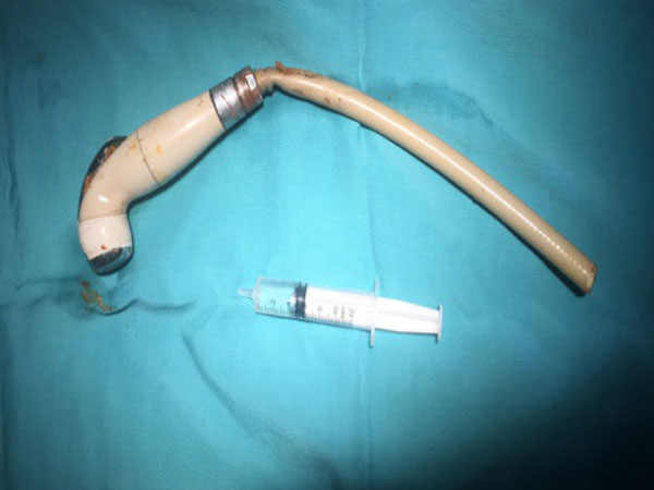 Vòi xịt vệ sinh kẹt trong hậu môn thanh niên 18 tuổi