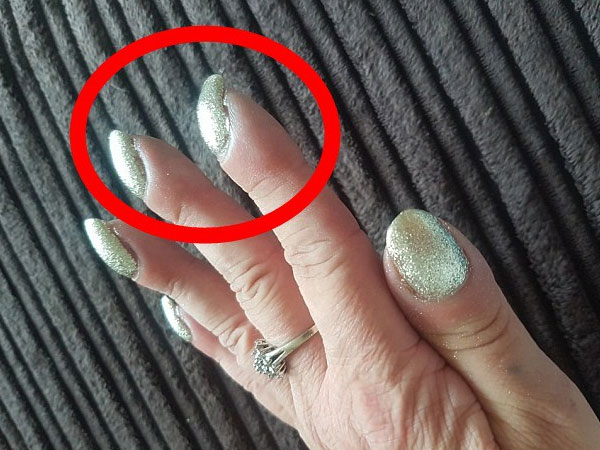 Nếu móng tay quặp vào kỳ lạ như người phụ nữ này, bạn nên nhanh chóng đi khám bác sĩ vì đó là dấu hiệu căn bệnh 'tử thần'