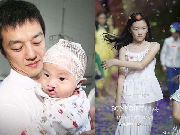 Con gái 13 tuổi khuyết tật của Lý Á Bằng: Cuộc sống nhiều tổn thương và khác người