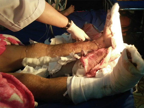 Nam thanh niên bị kẻ lạ chém đứt lìa 2 bàn chân