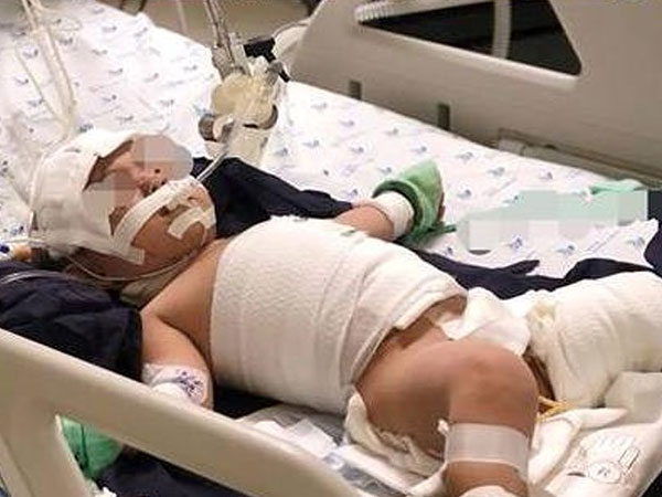 Mắc dây ấm đun siêu tốc, bé 20 tháng tuổi bỏng nặng