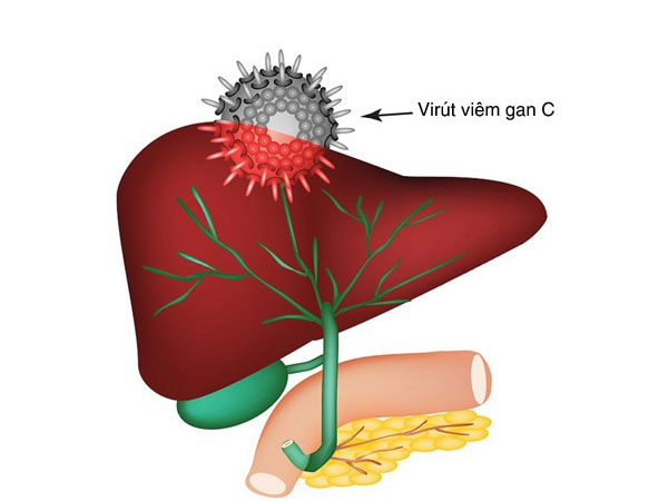 Viêm gan siêu vi C và các biến chứng thường gặp