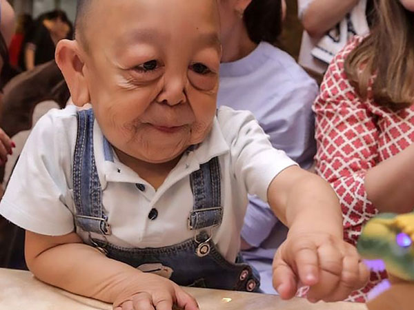 Bệnh lạ khiến bé 6 tuổi trông như ông cụ