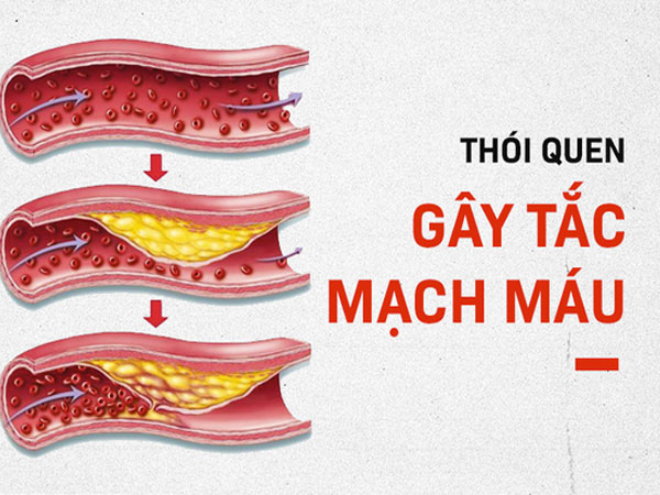 6 thói quen 'phá hủy' mạch máu: Nguyên nhân gây đột quỵ, tử vong mà nhiều người không biết