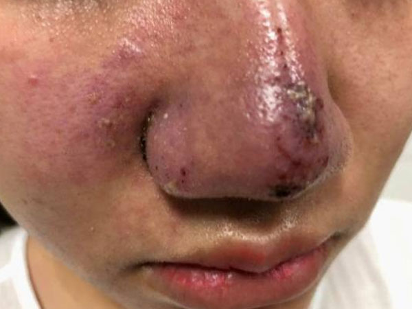 Hà Nội: Một phụ nữ méo mặt, mũi bọc mủ vì tiêm filler làm đẹp