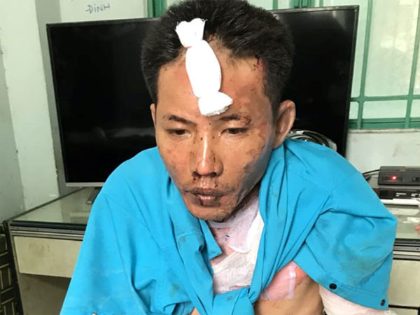 Hai bé gái bị cha dượng tưới xăng thiêu sống đã tử vong