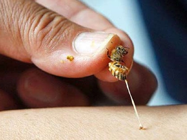 Chọc phá tổ ong, bé trai 5 tuổi suy đa phủ tạng nguy kịch