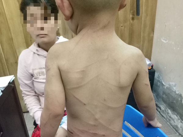 Đã có kết luận thương tích bé trai bị cha dượng đánh dã man ở Phú Quốc