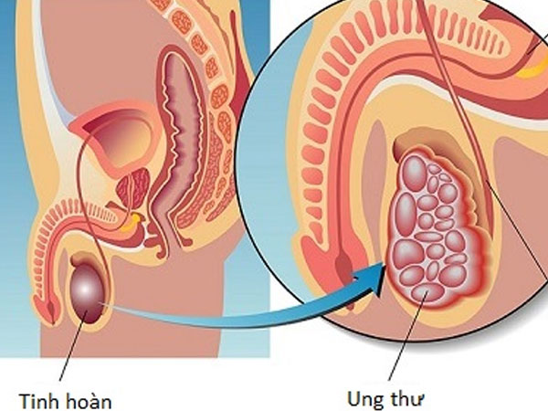 Ung thư tinh hoàn: Biết sớm, chữa nhanh