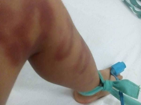 Bé trai 4 tuổi nguy kịch do người tình của mẹ bạo hành dã man