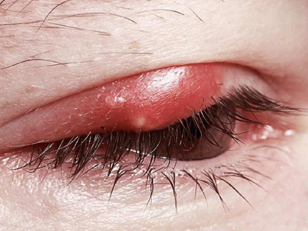 Chữa lẹo mắt nhanh khỏi nhất: Mẹo nhỏ 'dắt túi' khi cần, không để lại sẹo và đơn giản