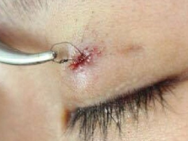 Nhấn mí mắt thẩm mỹ, sau 1 năm sợi chỉ lồi ra ngoài gây nhiễm khuẩn