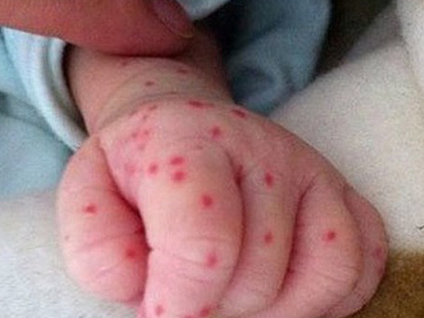 Triệu chứng bé bị sốt xuất huyết