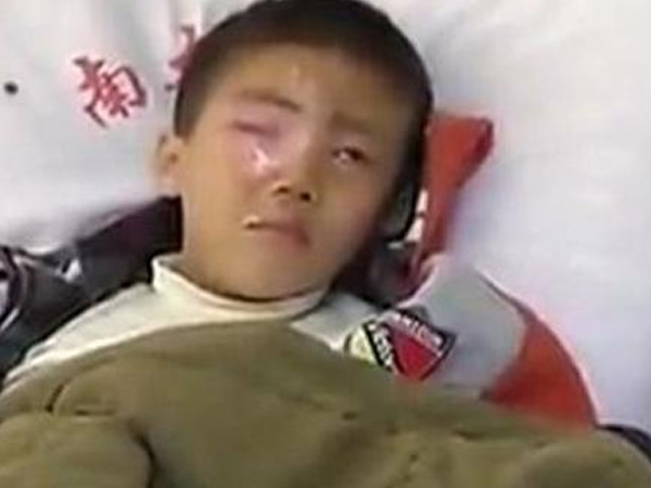 Bé trai mù mắt vì nghịch ngợm gói hút ẩm, đồ vật này tuyệt đối để xa tầm tay trẻ