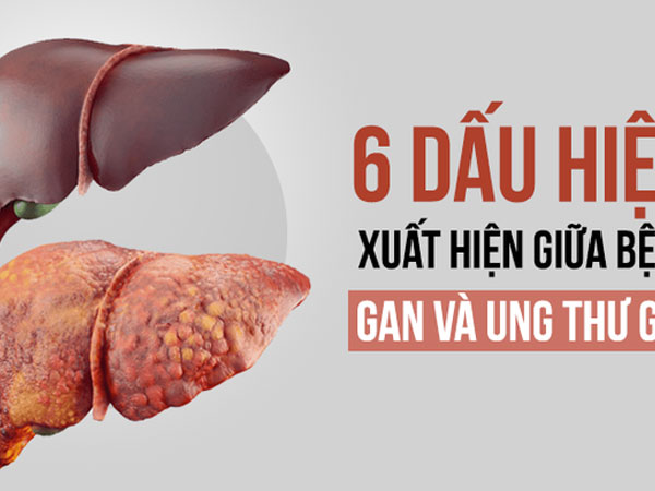 6 dấu hiệu cảnh báo khi bệnh gan tiến triển thành ung thư: Phát hiện sớm là rất quan trọng