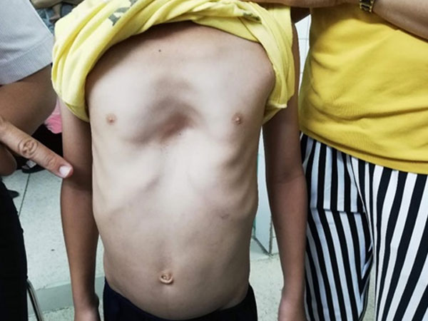 Bé trai mắc dị tật hiếm: Vừa mang nang tuyến phổi khổng lồ vừa bị lõm ngực nặng