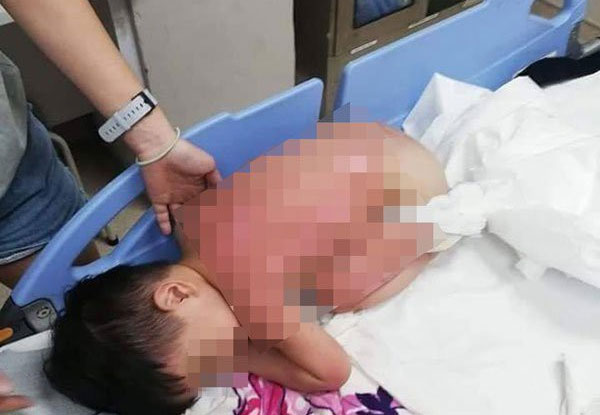 Cùng mẹ chơi dưới bếp, bé trai 2 tuổi bị bỏng nặng khi mặt bếp bất ngờ phát nổ, lời cảnh báo đáng sợ dành cho các phụ huynh