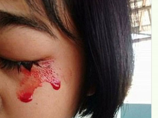 'Mồ hôi máu' - căn bệnh kỳ bí đối với y khoa thế giới