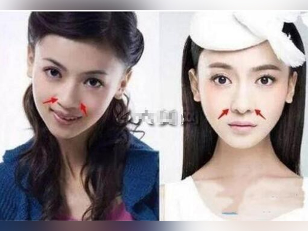 'Ngụy Anh Lạc' Ngô Cẩn Ngôn bị tố độn cằm, gọt mặt V-line, nhan sắc năm xưa khác xa bây giờ