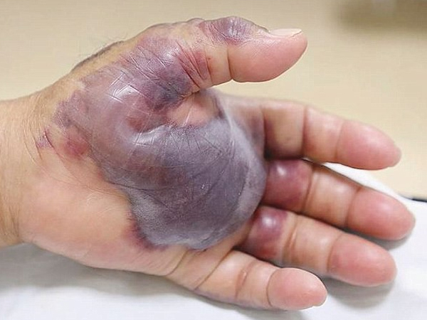 Bị cắt cụt tay chỉ vì ăn món khoái khẩu này: Chuyên gia cảnh báo một thói quen ăn uống dễ dẫn đến cái kết đắng!