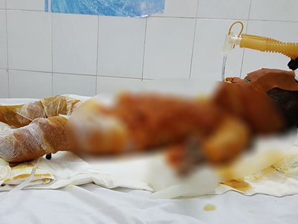 Sóc Trăng: Bố mẹ vắng nhà, 3 chị em chơi đốt rác khiến bé gái 20 tháng tuổi bỏng nặng đến 90%