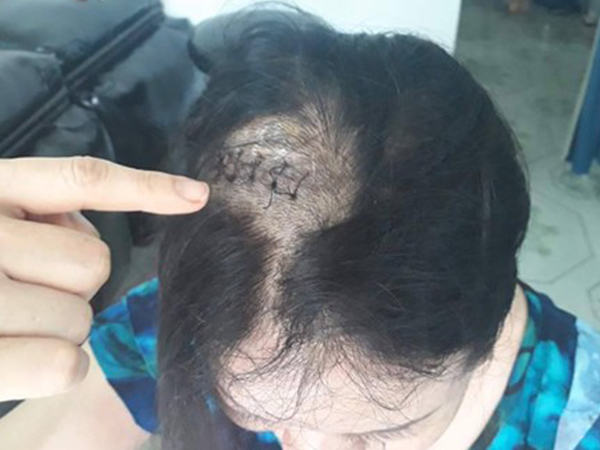 Đèn sân khấu rơi trúng đầu, bệnh viện chẩn đoán tai nạn giao thông