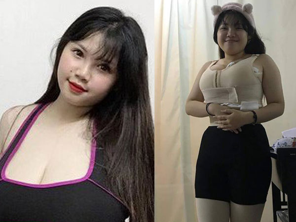 Nữ sinh 'siêu vòng 1' bất ngờ xuất hiện với thân hình eo ót sau khi hút 9 lít mỡ thừa