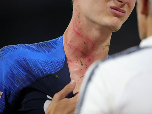Hậu vệ Chelsea lên tiếng sau pha phạm lỗi làm rách cổ Benjamin Pavard