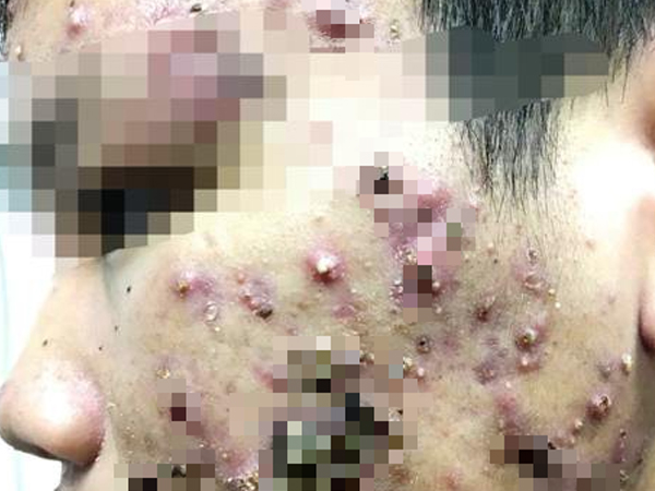 Hãi hùng mặt lở loét, mọc đầy lông vì dùng kem trộn chữa trứng cá, nám má
