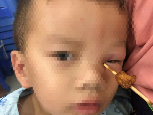 Vấp ngã khi chạy phụ cha đẩy xe, bé trai 4 tuổi bị xiên cá viên đâm sâu vào hốc mắt