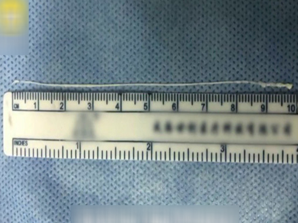 Trung Quốc: Sán dây dài 10 cm chui vào não thanh niên mê đồ nướng