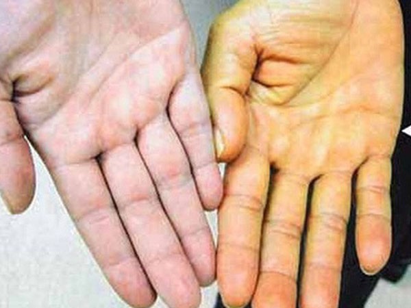Bác sĩ Bệnh viện K chia sẻ các dấu hiệu 'vàng' cảnh báo bệnh ung thư gan