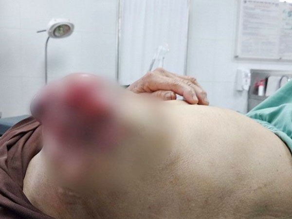 Hãi hùng ngực lở loét, chảy dịch vì đắp lá chữa ung thư vú suốt 3 năm